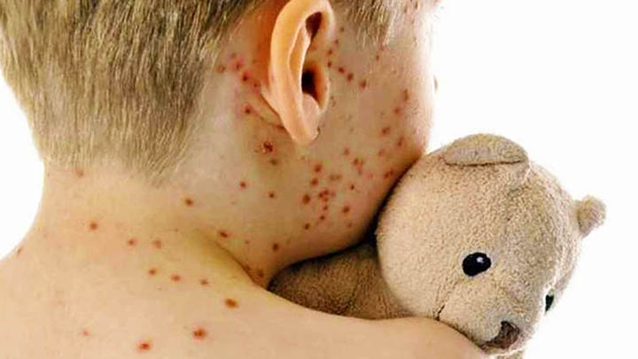 aumento dei casi di morbillo
