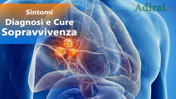 tumore ai polmoni sintomi diagnosi cure sopravvivenza